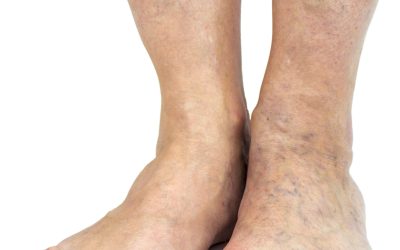 Varicose And Spider Vein Treatment Methods Are More Effective Than You May Think