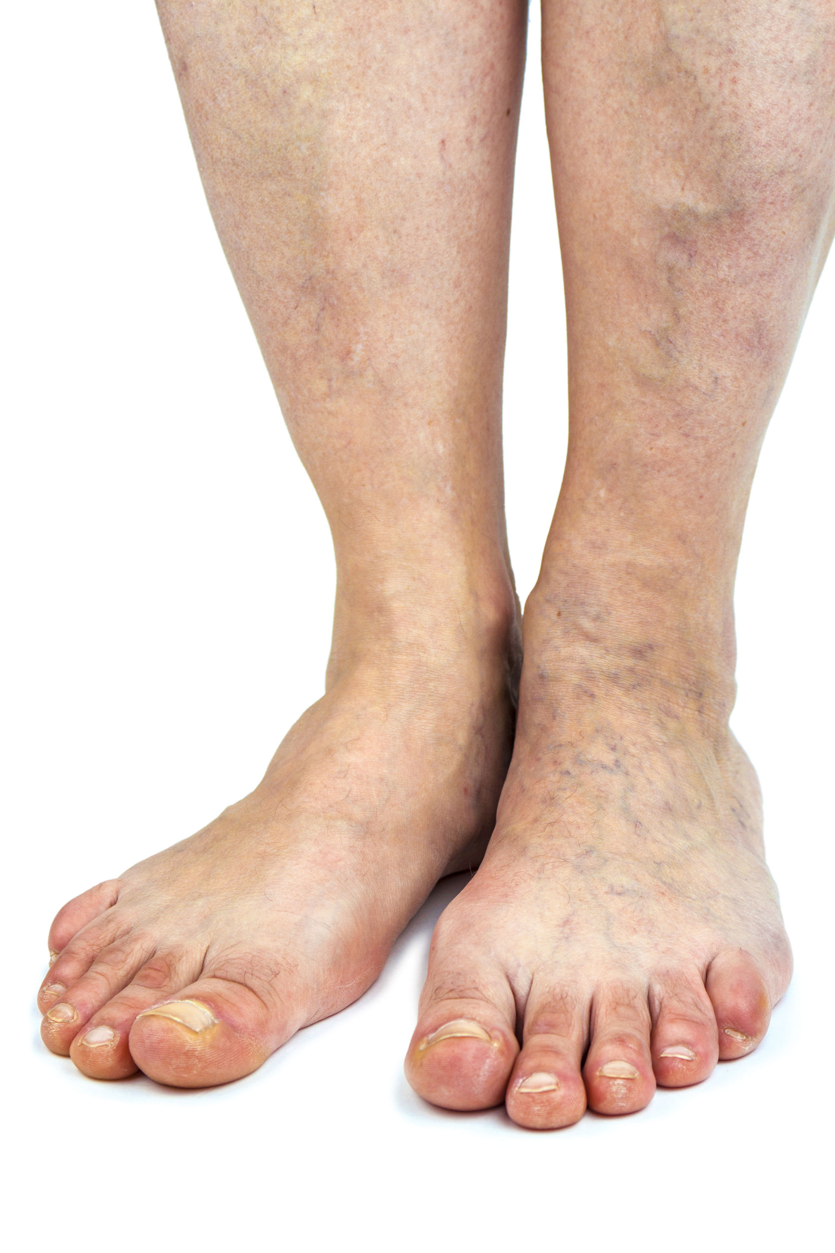 When to Visit a Center for Vein Restoration in Pennsylvania for Varicose Vein Diagnosis