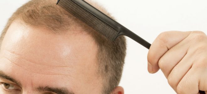 3 Reasons to Proceed With a Hair Restoration Treatment in Philadelphia, PA