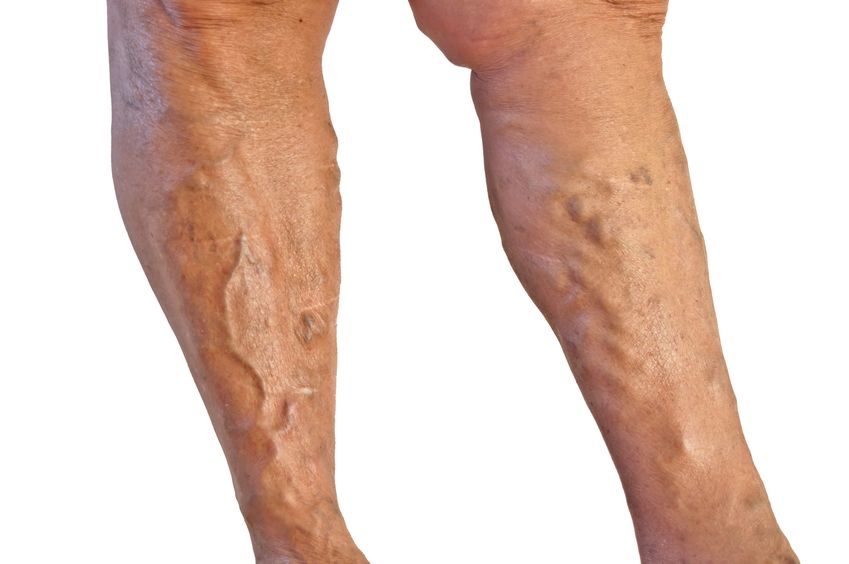 Should You Talk to a Doctor About Varicose Vein Treatment in Hamilton, NJ?