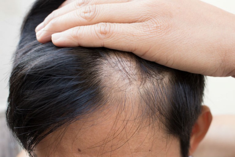 Comparing the Two Common Types of Hair Transplant Repair in Philadelphia