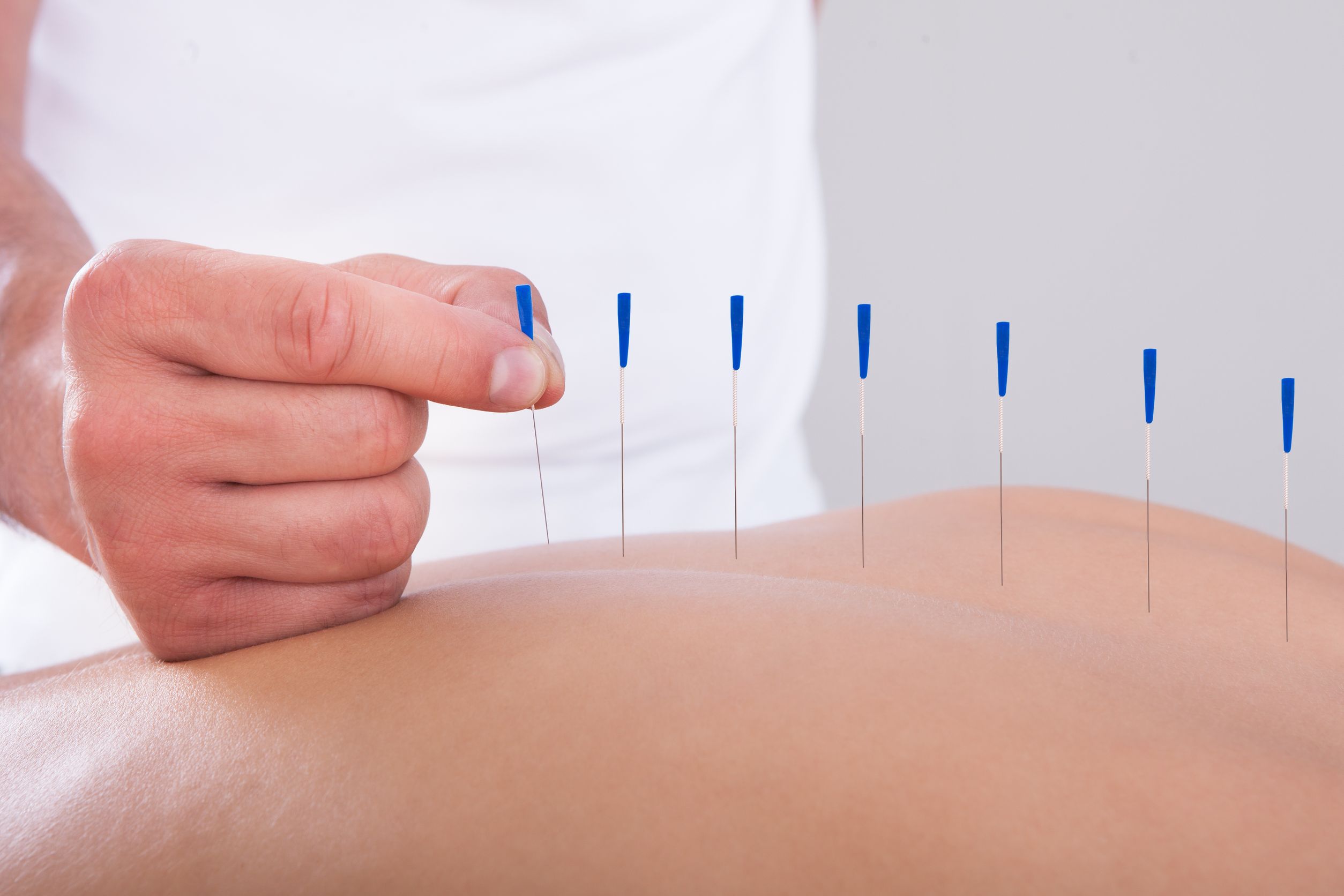 You Should Try Expert Dry Needling in Helena, MT