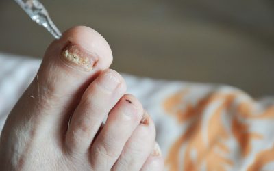 Clear Nails, Confident Feet: Finding the Right Toenail Fungus Treatment in Jacksonville, FL