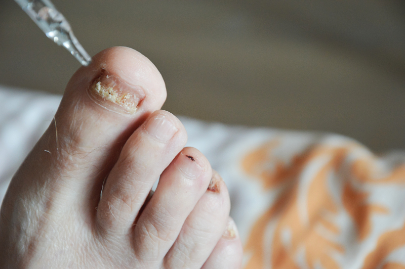 Clear Nails, Confident Feet: Finding the Right Toenail Fungus Treatment in Jacksonville, FL