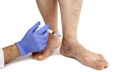 Managing Leg Swelling in San Bernardino, CA: Options for Long-Term Comfort and Health